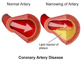 Coronary Artery Disease Treatment at Livasa Mohali - CAD Management